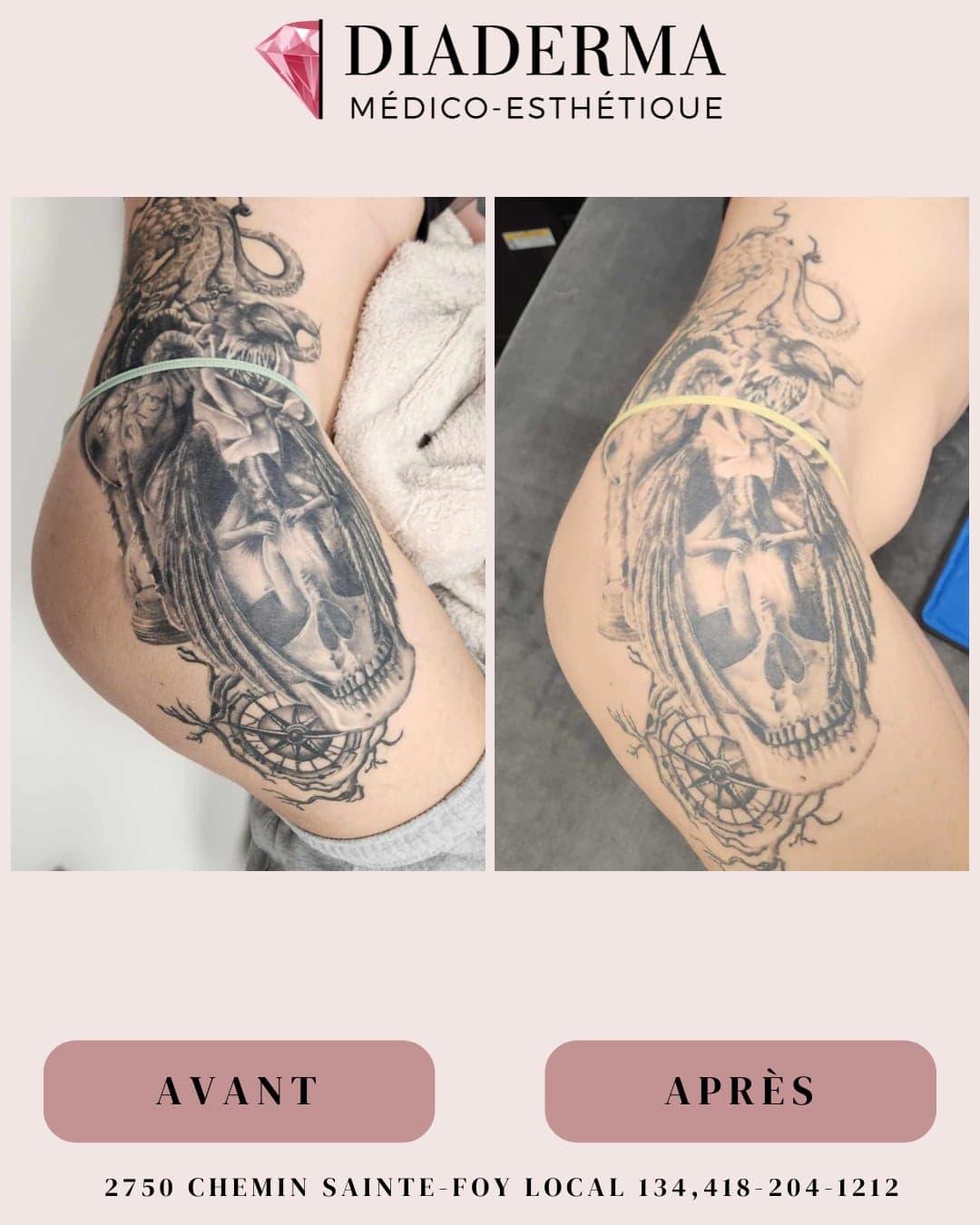 Avant-Après1